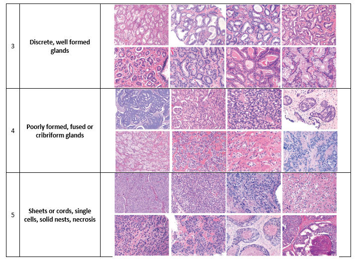 Prostate Cancer Pathology The Urology Guy 